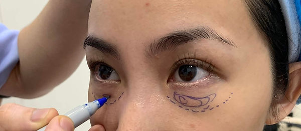 Crisp Eye Bag Laser Photo for Your Screen Crisp Eye Bag Laser Photo for Your Screen
